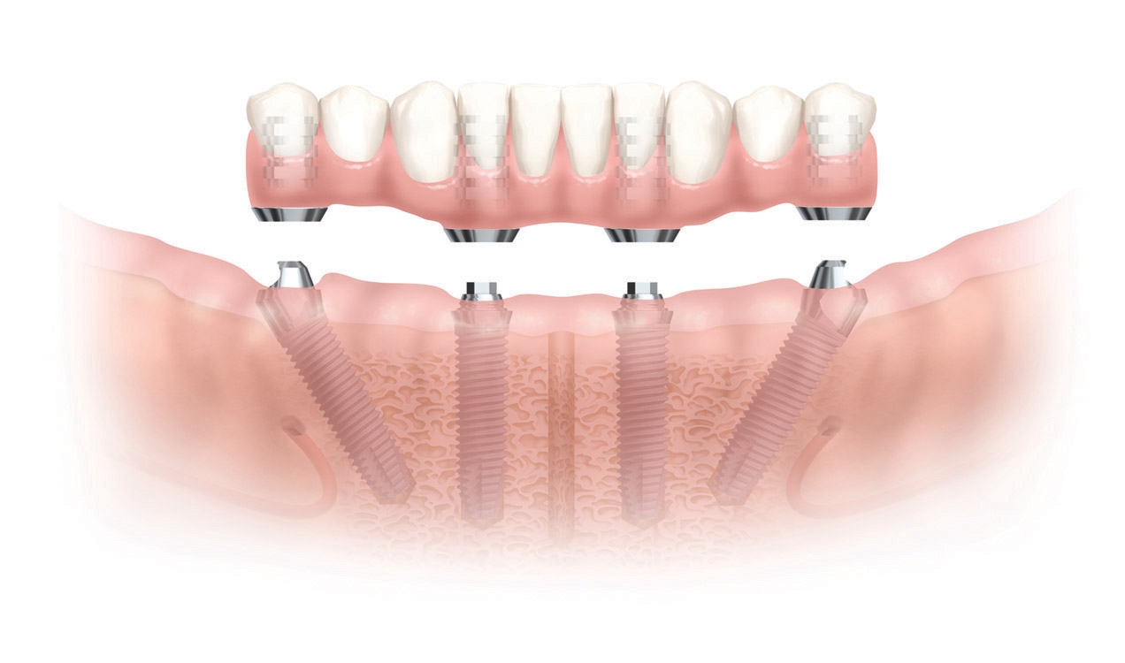 dental-implants-beautiful-teeth-in-a-day.jpg